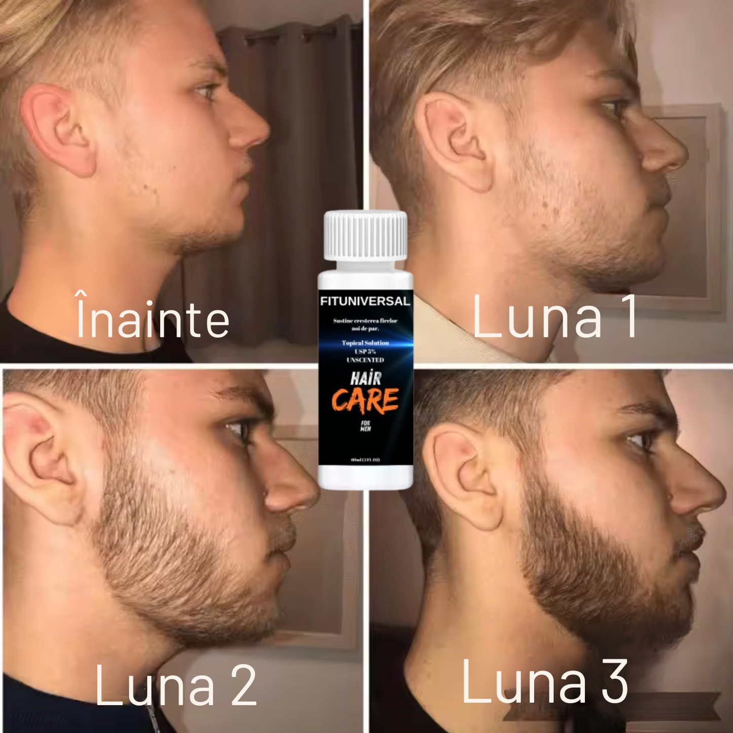 Set Minoxidil 2+1 GRATUIT tratament crestere si regenerare fire de par FITUNIVERSAL Minoxidil 5%, pentru 3 luni
